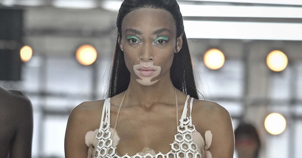Winnie Harlow: Panikattacke bei Victoria's Secret