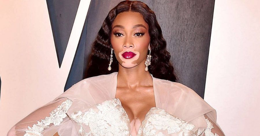 Winnie Harlow über Augenringe und ihre Hautkrankheit