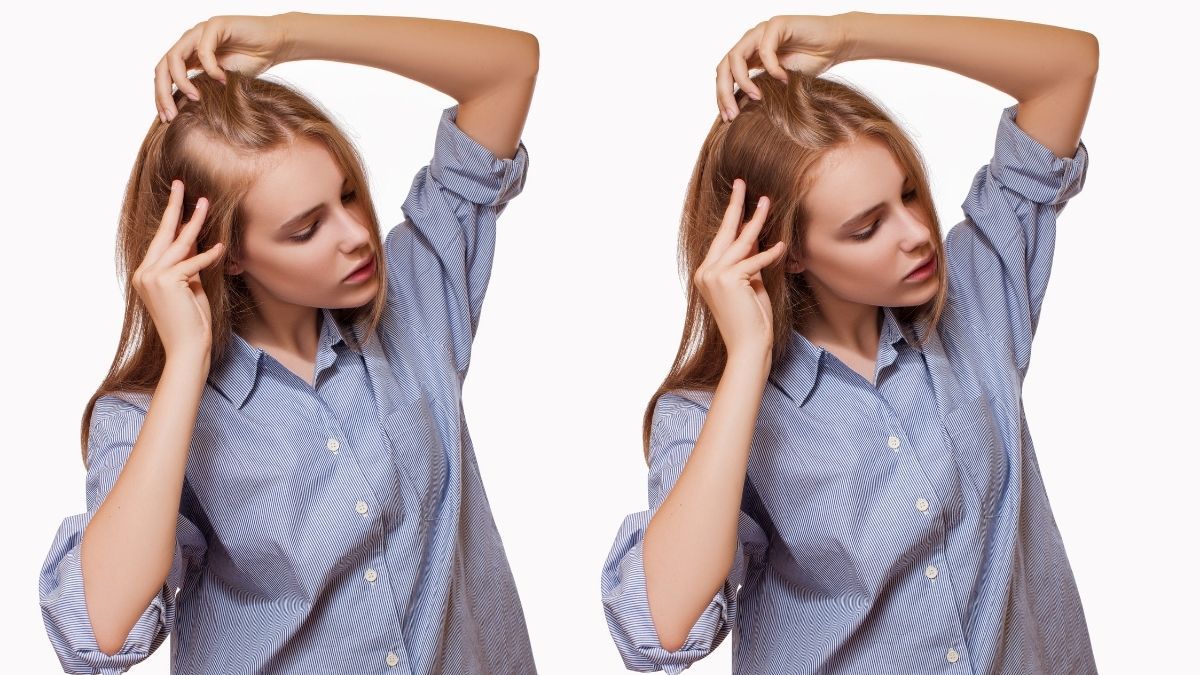 Geheimratsecken bei Frauen: Effektiv behandeln mit Haarlinienkorrektur