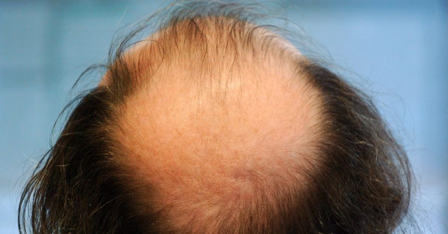 Schreck eines jeden Mannes: Haarausfall.