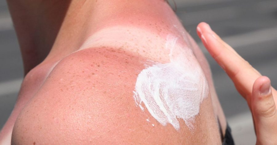 Hier kommt die Sonnencreme zu spät, die Haut ist schon verbrannt. Was hilft nun noch?
