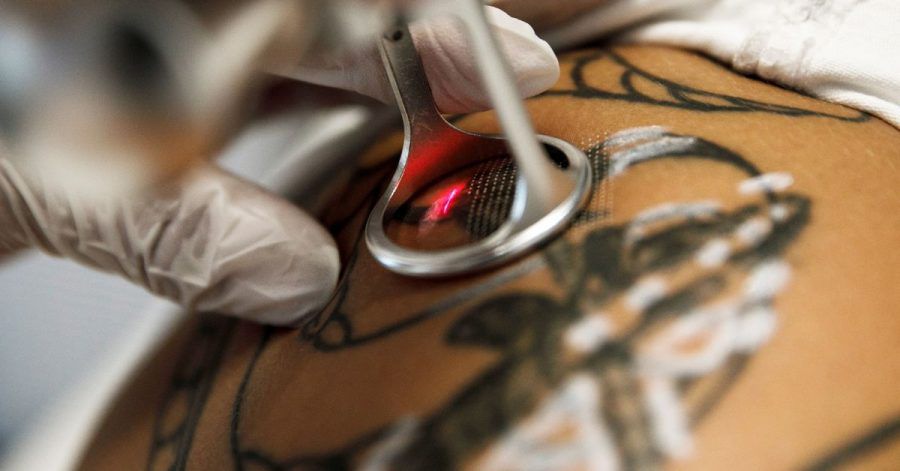 Wird ein Tattoo per Laser entfernt, muss die Behandlung in der Regel mehrmals wiederholt werden.