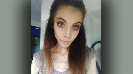 Ist das Kunst oder krank? Mager-Model Wilkomira