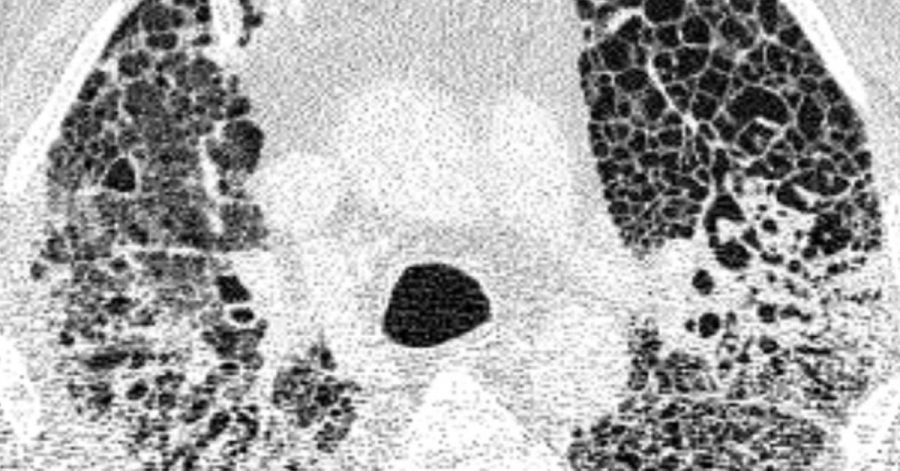 Computertomographie-Aufnahme (CT-Bild) der Lunge eines Patienten mit COVID-19-Lungenversagen. Helle Bereiche zeigen Verdichtungen und Vernarbungen des Lungengewebes.