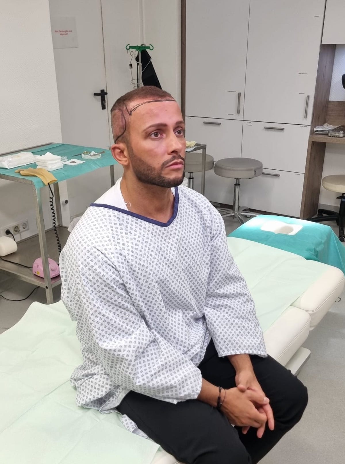 Domenico de Cicco schwört dem Haarteil ab: Er macht Haartransplantation