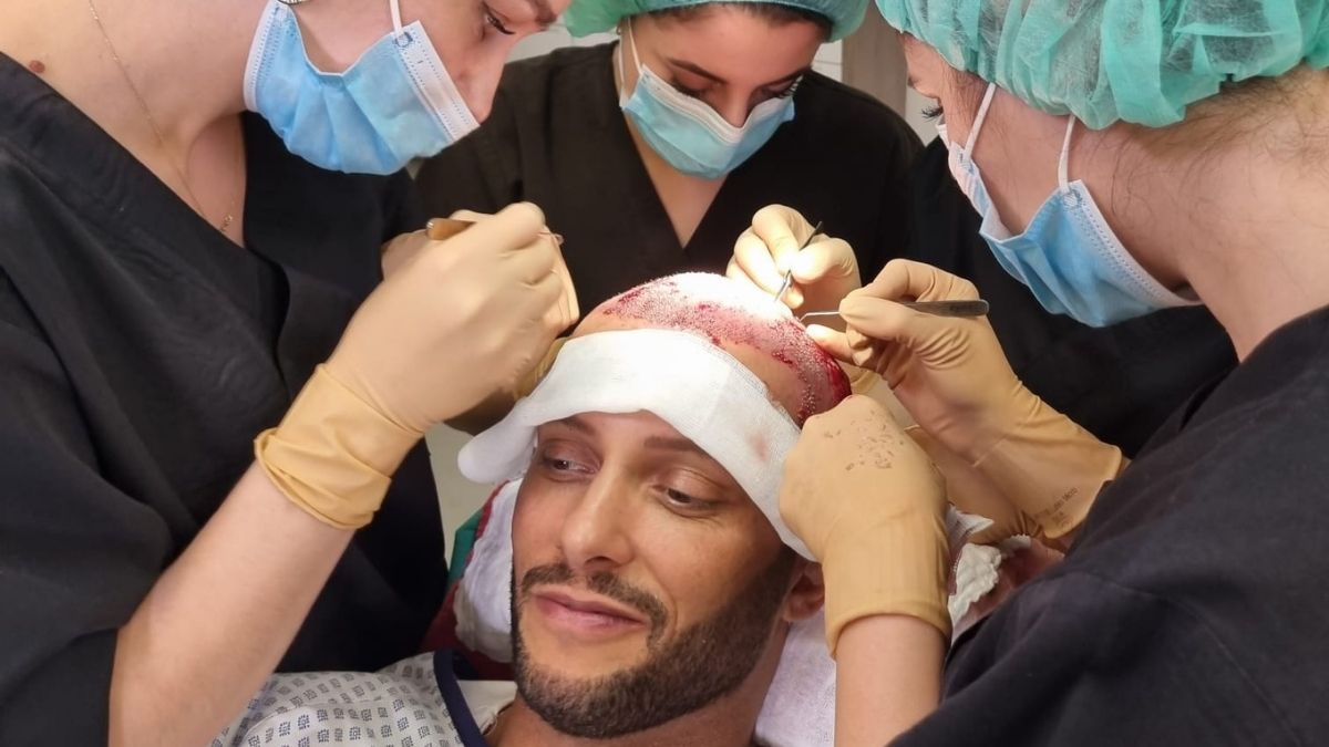 Domenico de Cicco schwört dem Toupet ab: Er macht Haartransplantation
