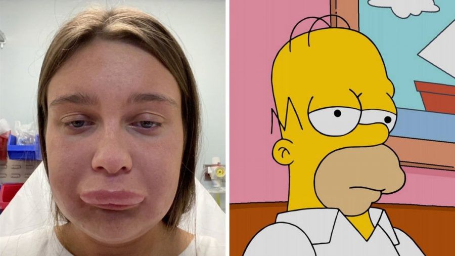 Lippenfiller auflösen geht schief: Frau sieht aus wie Homer Simpson!