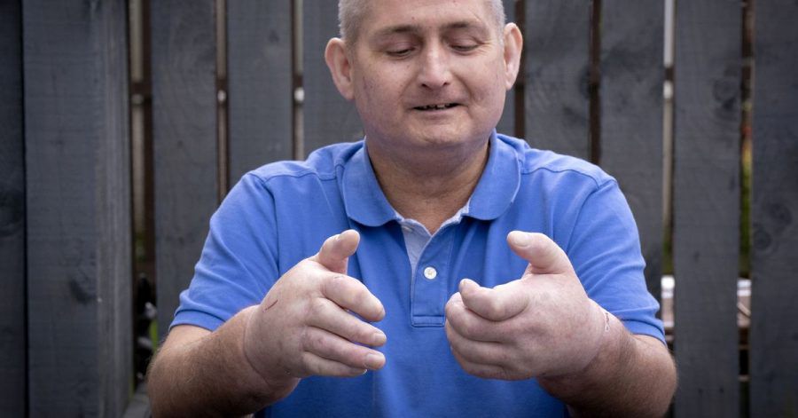 Steven Gallagher wurden zwei Hände transplantiert.
